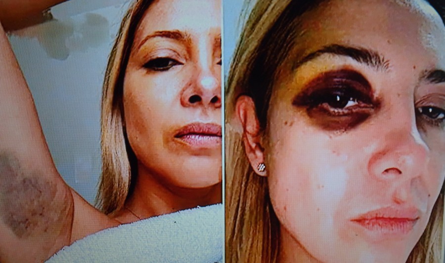 MARCAS. Fabiola Yáñez con un ojo golpeado, una de las fotos que forma parte de la denuncia contra Alberto Fernández.