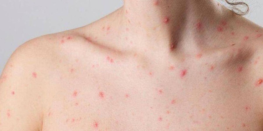 VIRUELA DEL MONO. Se confirm&oacute; un caso positivo sin antecedentes de viaje en la Argentina.