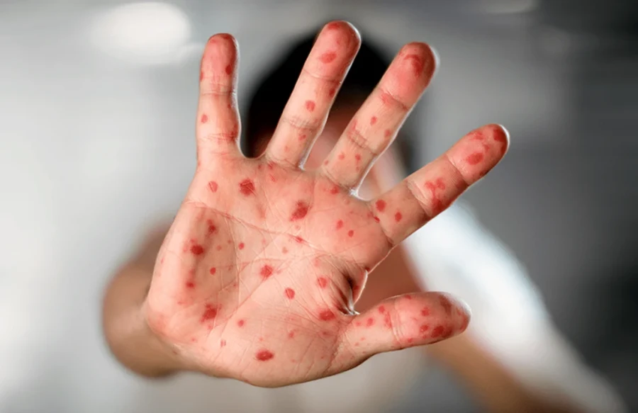 Mpox, emergencia de Salud Pública.