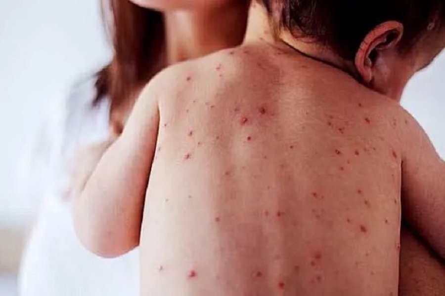 EN ALERTA. Crecen de manera preocupante los contagios de sarampión en el territorio nacional.