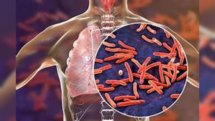 INFECCIONES. Fuerte preocupación por el crecimiento de los casos de una enfermedad respiratoria en el país.