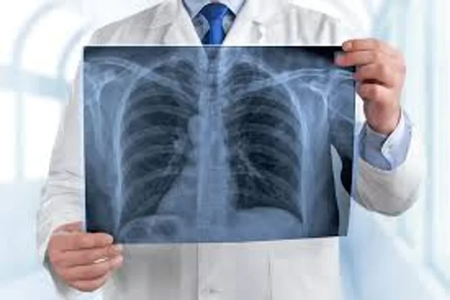 La visita al médico es fundamental para detectar a tiempo el cáncer de pulmón.