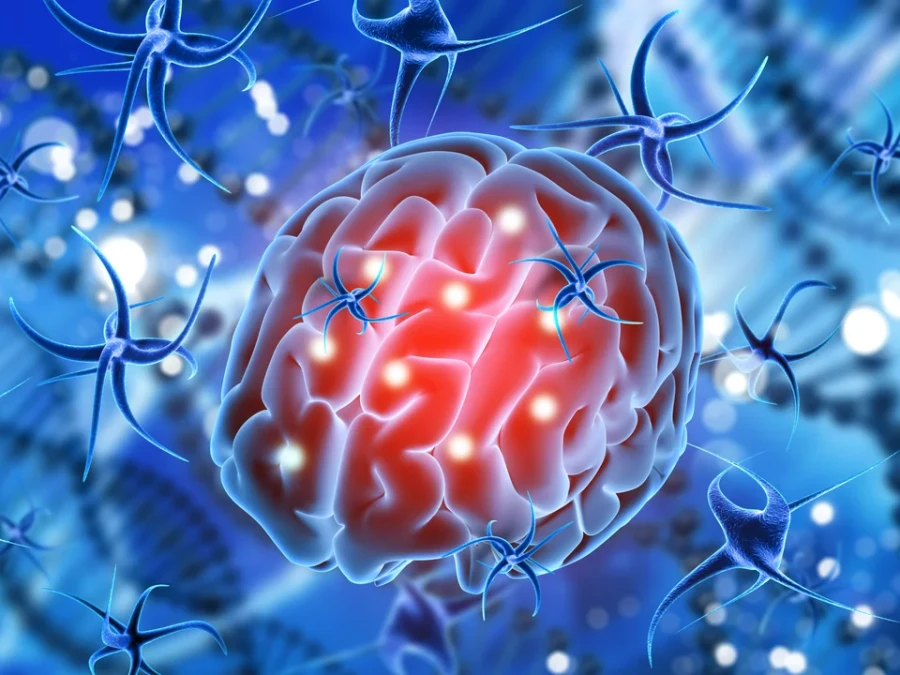 El glioma es un tipo de tumor que se desarrolla en el cerebro.